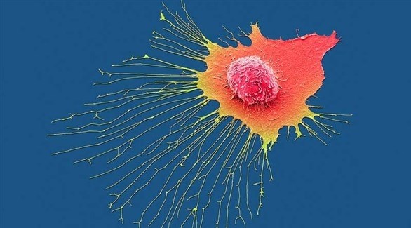 علاج كهرومغناطيسي يمنع انتشار سرطان الثدي