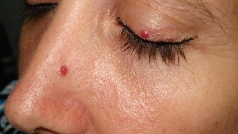 الشامات الحمراء على بشرتك قد تكون نوعاً من سرطان الجلد