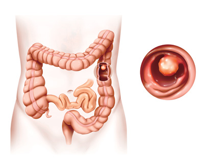 what is colonoscopy - المجلة الطبية