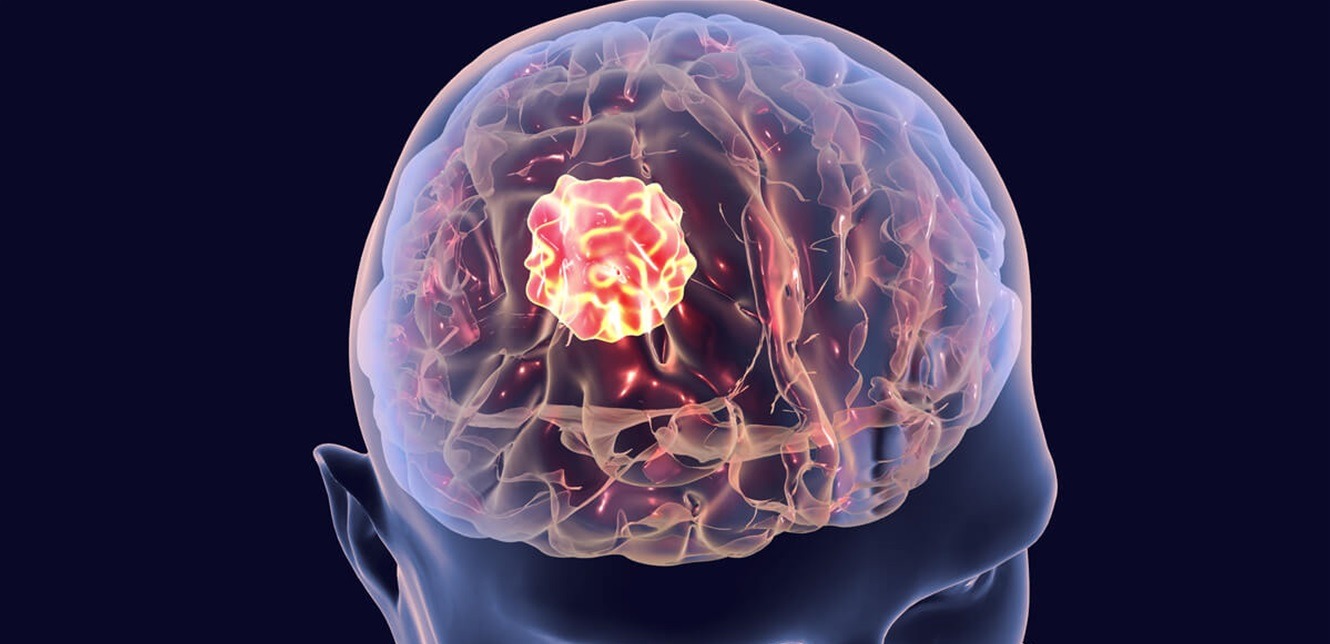 أطباء يبتكرون علاجاً لسرطان الدماغ بالحقن