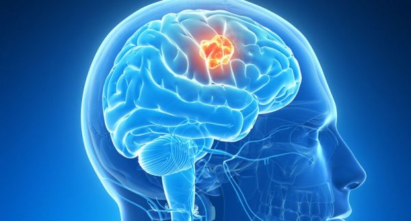 طبيبة تحدد الأعراض الرئيسية لسرطان الدماغ