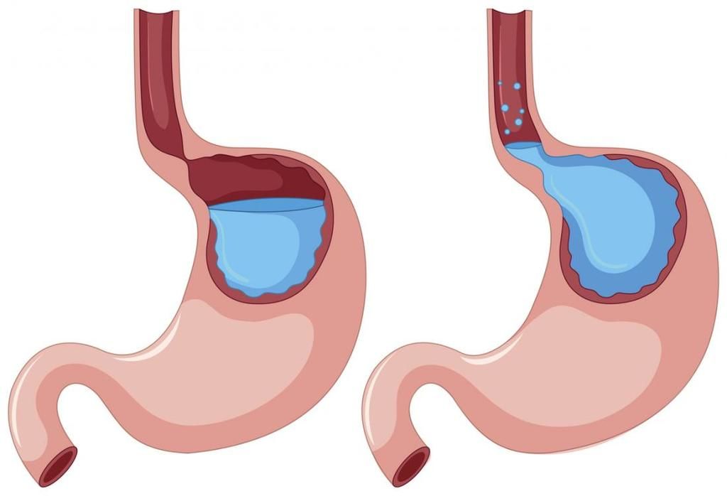 gerd diagram - المجلة الطبية