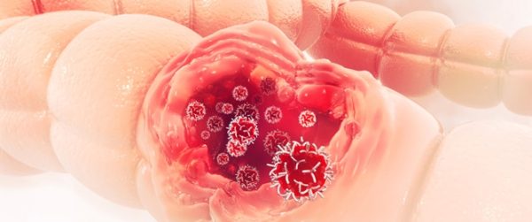 دراسة: المضادات الحيوية تزيد من خطر الإصابة بسرطان القولون