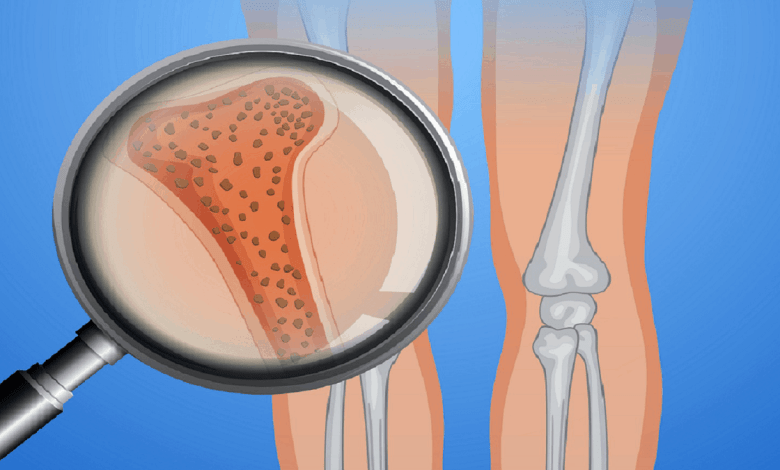 Osteoporosis - المجلة الطبية