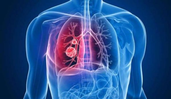 عدوى تنفسية تستأثر بنسبة 15% من مجموعة وفيات الأطفال