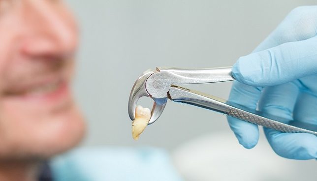خلع الضرس.. هل يؤثر على باقي الأسنان؟
