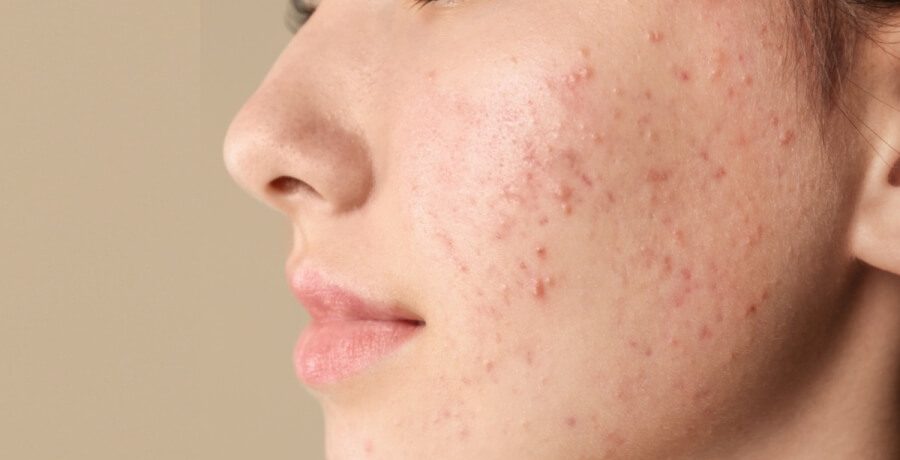 ما الذي يحدث للبالغين الذين يعانون من حب الشباب